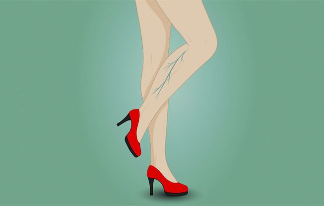 Varicose veins on the legs of a woman