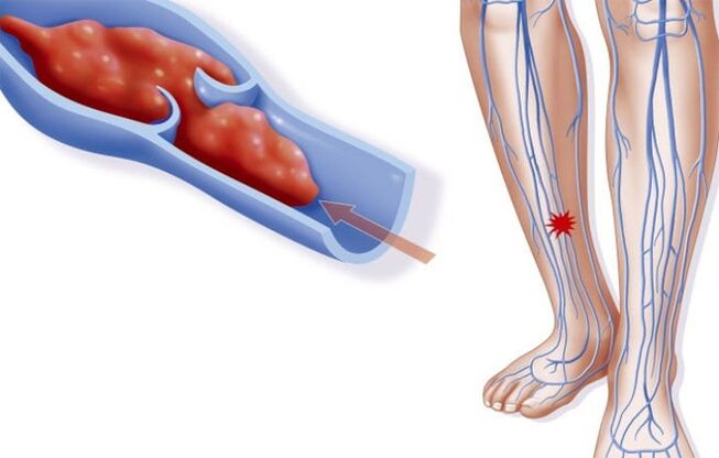 Thrombophlebitis