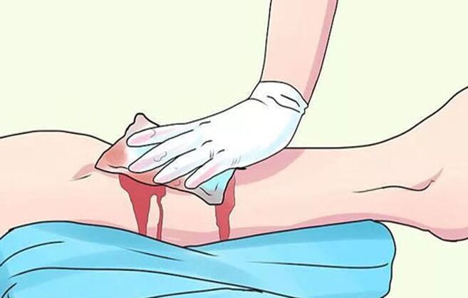 Venous bleeding