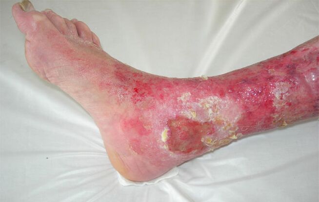 ulcers