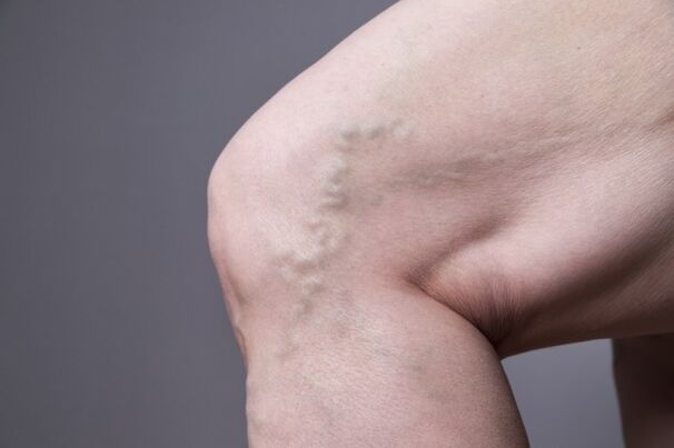 Varicose veins in women
