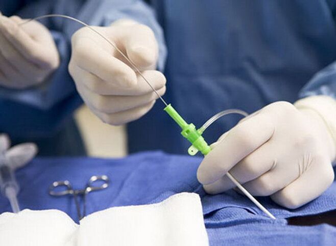 Radiofrequency ablation