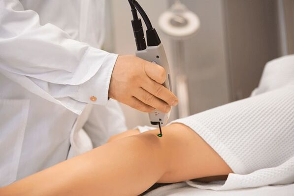 Laser coagulation of veins of the lower extremities