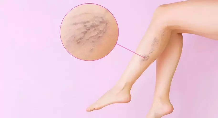 Tortuous protruding veins on the legs with varicose veins