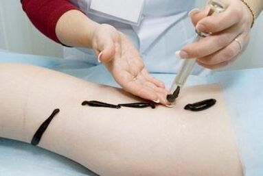 Leeches for varicose veins - an effective remedy for traditional medicine